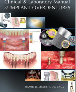 Ebook Clinical and Laboratory Manual of Implant Overdentures 1st Edition