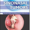 Sinonasal Tumors