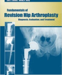 Fundamentals of Revision Hip Arthroplasty: Diagnosis, Evaluation, and Treatment 1st Edition