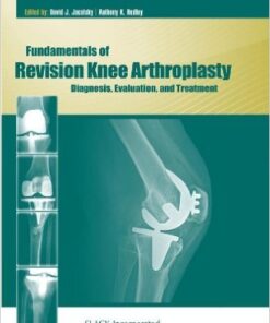 Fundamentals of Revision Knee Arthroplasty: Diagnosis, Evaluation, and Treatment 1st Edition