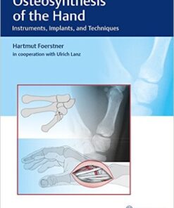 Osteosynthesis of the Hand: Instruments, Implants, and Techniques 1st Edition