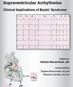Interatrial Block and Supraventricular Arrhythmias: Clinical Implications of Bayes' Syndrome PDF