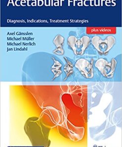 Acetabular Fractures: Diagnosis, Indications, Treatment Strategies 1st Edition PDF Original & Video