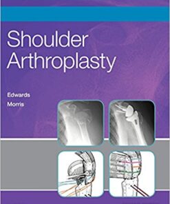 Shoulder Arthroplasty 2nd Edition PDF & Video