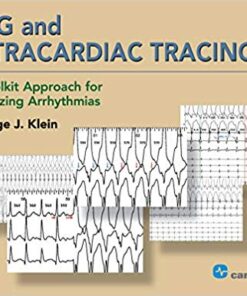 ECG and Intracardiac Tracings: A Toolkit Approach for Analyzing Arrhythmias, 2018 PDF