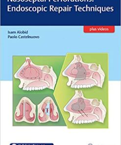 Nasoseptal Perforations: Endoscopic Repair Techniques 1st Edition