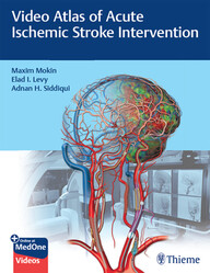 Video Atlas of Acute Ischemic Stroke Intervention 1st Edition