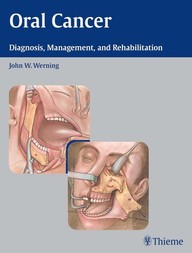 Oral Cancer: Diagnosis, Management, and Rehabilitation 1st Edition PDF