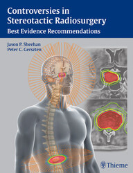 Controversies in Stereotactic Radiosurgery: Best Evidence Recommendations 1st Edition PDF