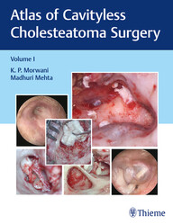 Atlas of Cavityless Cholesteatoma Surgery PDF