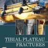 Tibial Plateau Fractures 1st Edition PDF Original