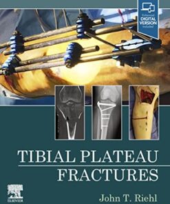 Tibial Plateau Fractures 1st Edition PDF Original