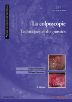 La Colposcopie Technique et Diagnostics