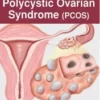 Decoding Polycystic Ovarian Syndrome (PCOS) Decoding Polycystic Ovarian Syndrome (PCOS)