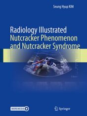 Radiology Illustrated: Nutcracker Phenomenon and Nutcracker Syndrome