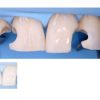 Direct and Indirect Adhesive Restorations