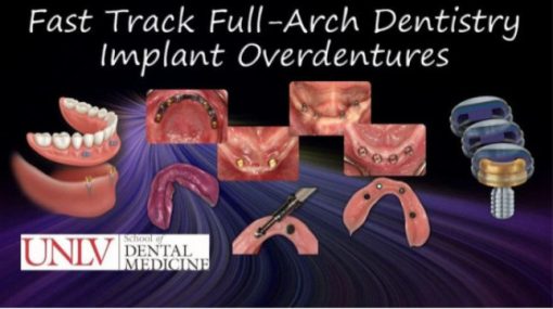 Full-Arch Dentistry – Implant Overdentures