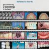 Introduction to Implant Prosthodontics