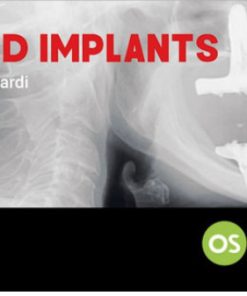 Tilted Implants: A Complete Surgical and Theoretical Guide to Tilted Implants