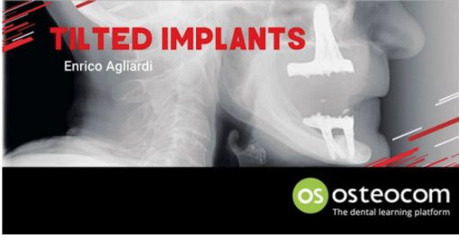 Tilted Implants: A Complete Surgical and Theoretical Guide to Tilted Implants