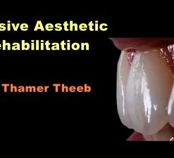 Dental Adhesive Aesthetic Rehabilitation