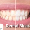DentalXP Dental Bleaching