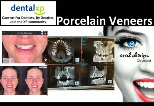 DentalXP Porcelain Veneers 