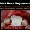 Guided Bone Regeneration