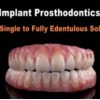 Implant Prosthodontics – From Single to Fully Edentulous Solutions