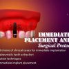 OHI-S Immediate Implant Placement and Loading