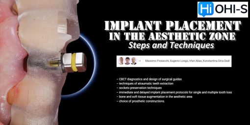 OHI-S Implant Placement in the Aesthetic Zone