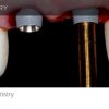 gIDE A to Z in Implant Dentistry