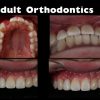 DentalXP Adult Orthodontics 