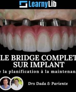 LearnyLib Le Bridge Complet sur Implant