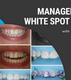 Management of White Spot Lesions 