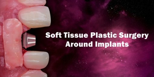 OHI-S Soft Tissue Plastic Surgery Around Implants