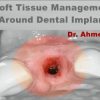 Soft Tissue Management Around Dental Implant