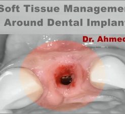 Soft Tissue Management Around Dental Implant