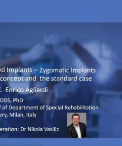 Tilted and Zygomatic Implants