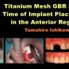 Titanium Mesh GBR at the Time of Implant Placement in the Anterior Region