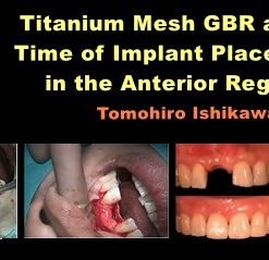 Titanium Mesh GBR at the Time of Implant Placement in the Anterior Region