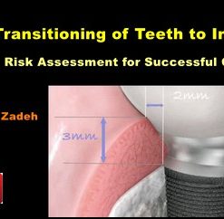 Transitioning of Teeth to Implants