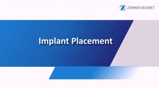 Zimmer Biomet Implant Placement
