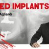 Tilted Implants - Enrico Agliardi