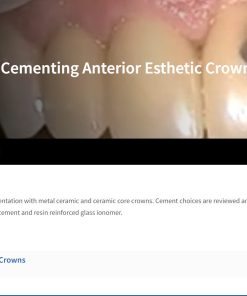 Cementing Anterior Esthetic Crowns