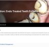 Endo Treated Teeth Esthetic Management