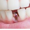 Immediate Single Tooth Anterior Implants