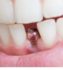 Immediate Single Tooth Anterior Implants