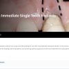 Immediate Single Tooth Implants