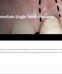 Immediate Single Tooth Implants